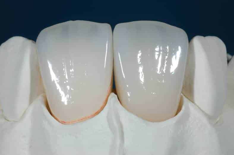ambition Implications pin Corona ceramica integrale - Dentista Implantologia Prezzi